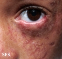 bloom syndrome