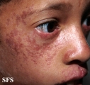 bloom syndrome