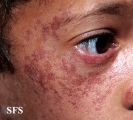 bloom syndrome