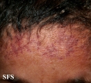 bloom syndrome
