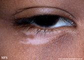 vitiligo
