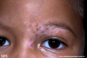 vitiligo