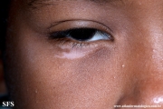 vitiligo