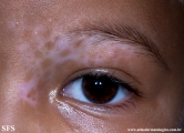 vitiligo