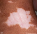 vitiligo