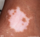 vitiligo