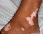 vitiligo
