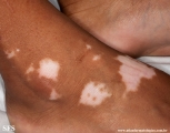 vitiligo