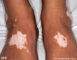 vitiligo