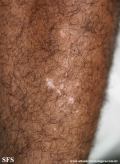 vitiligo
