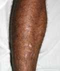 vitiligo