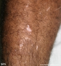 vitiligo