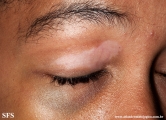 vitiligo