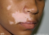 vitiligo