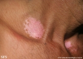 vitiligo