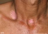 vitiligo