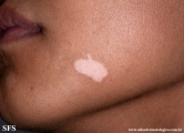 vitiligo