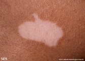 vitiligo