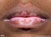 vitiligo