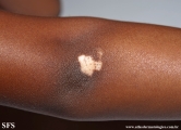 vitiligo