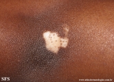 vitiligo