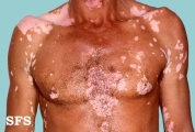 vitiligo