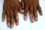 vitiligo