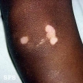 vitiligo