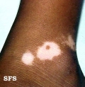 vitiligo