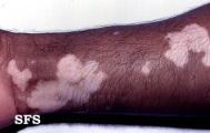 vitiligo