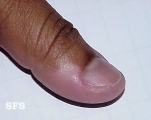 vitiligo