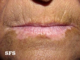 vitiligo