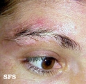 vitiligo