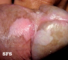 vitiligo