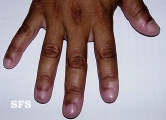 vitiligo