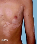 vitiligo