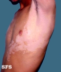 vitiligo
