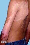 vitiligo