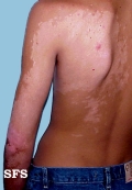 vitiligo