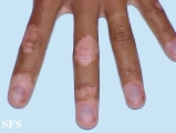vitiligo
