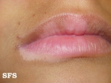 vitiligo