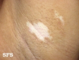 vitiligo