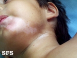 vitiligo