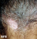 vitiligo