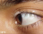 vitiligo
