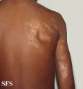 vitiligo