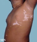 vitiligo