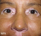 vitiligo