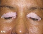 vitiligo