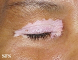 vitiligo